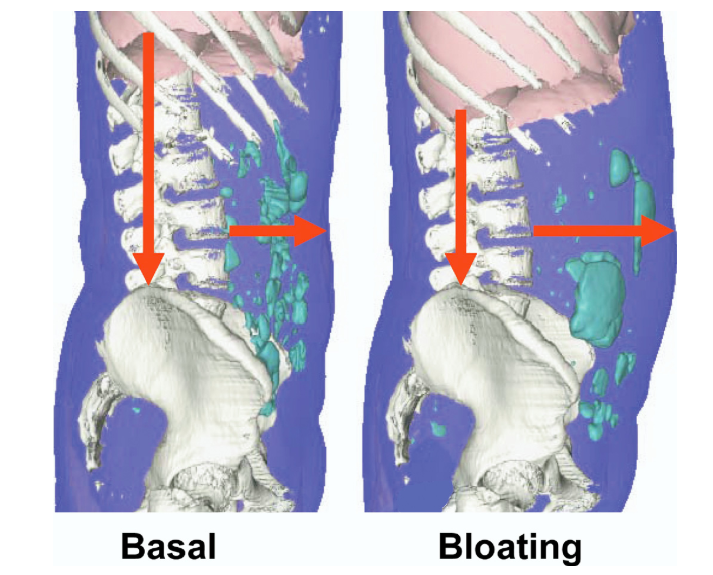 Bloating and Distension: What’s the Difference?