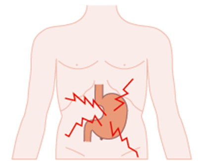 Functional Dyspepsia