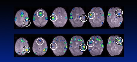 Change in brain from trauma before and after treatment